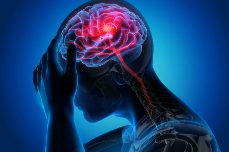 Možganska kap – tretji najpogostejši vzrok smrti